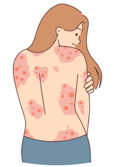 Psoriasis<br />
Vérane Geronimi sophrologie et hypnose Toulouse